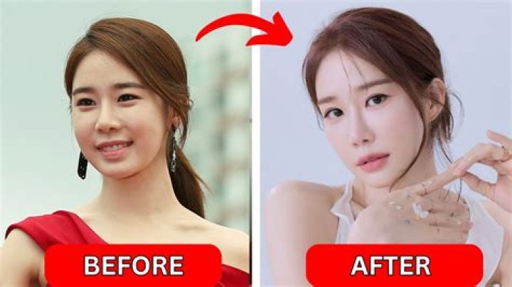 Korean Celebrities: The Transformation Journey Before And After Surgery