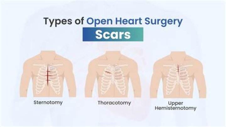 Understanding Scar Heart Surgery: A Journey Towards Healing